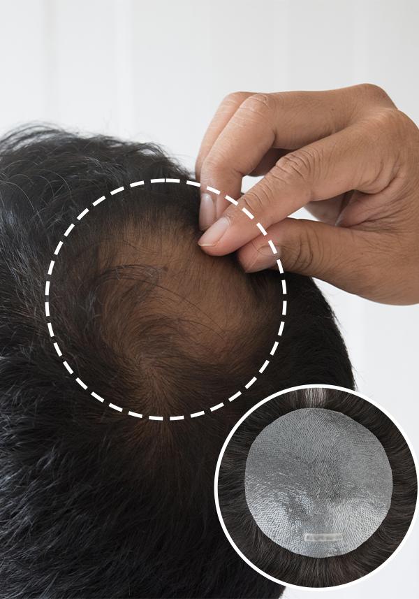 Complément Capillaire Hommes Pour La Perte De Cheveux De La Couronne 