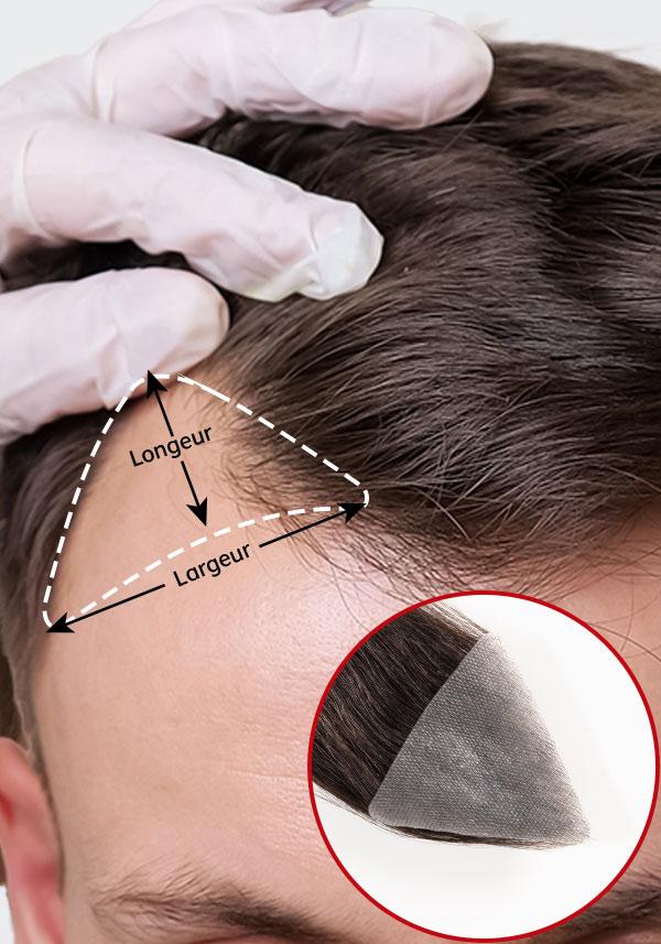 Patchs Capillaire Triangle Hommes