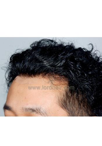 l20 hair replacement system