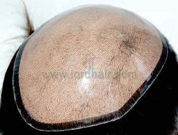 silicon injected hair replacement system
