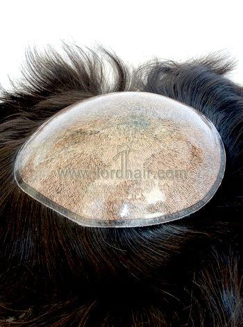 silicon injected hair replacement system