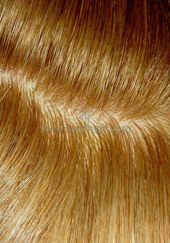 silicon injected hair replacement system