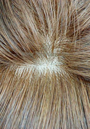 silicon injected hair replacement system