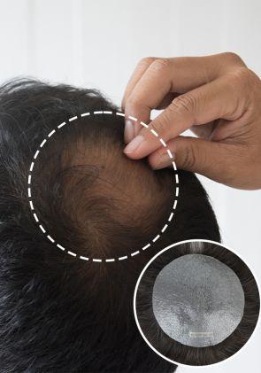 Complément Capillaire Hommes Pour La Perte De Cheveux De La Couronne 