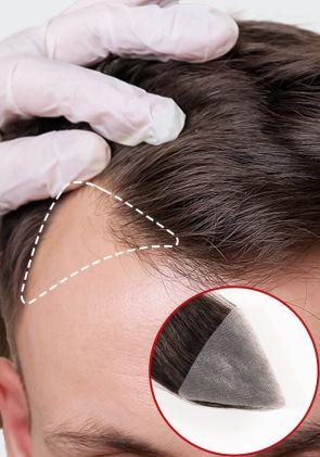 Patch Capillaire Triangle Base en peau fine de 0.06mm