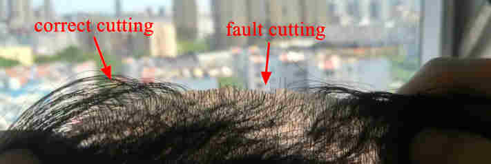 How to Cut the Extra Skin with V-Loop Front System?