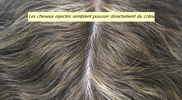S21 cheveux injectés