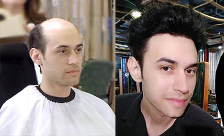 Ultra Thin Skin Hair Systems for Men