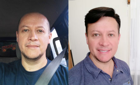 Lace Front and Thin Skin Back and Sides